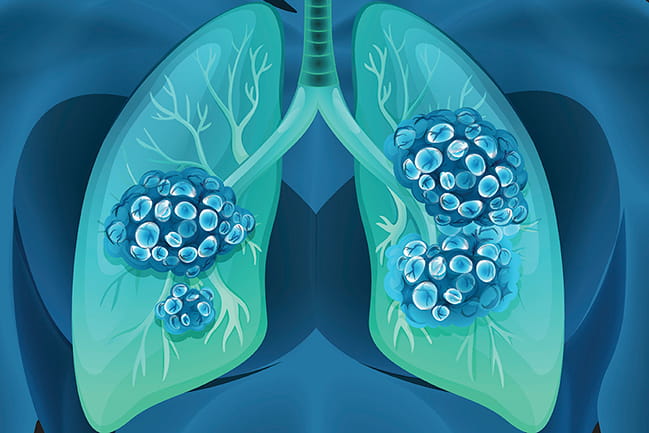 A Rule-Out Blood Test for Cancer Lungs